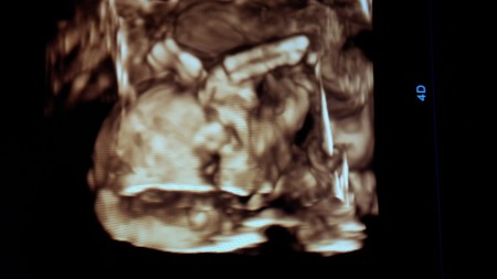Renkli Ultrasonda Bebegin Sacli Oldugu Anlasilirmi Hamilelik Donemi Genel